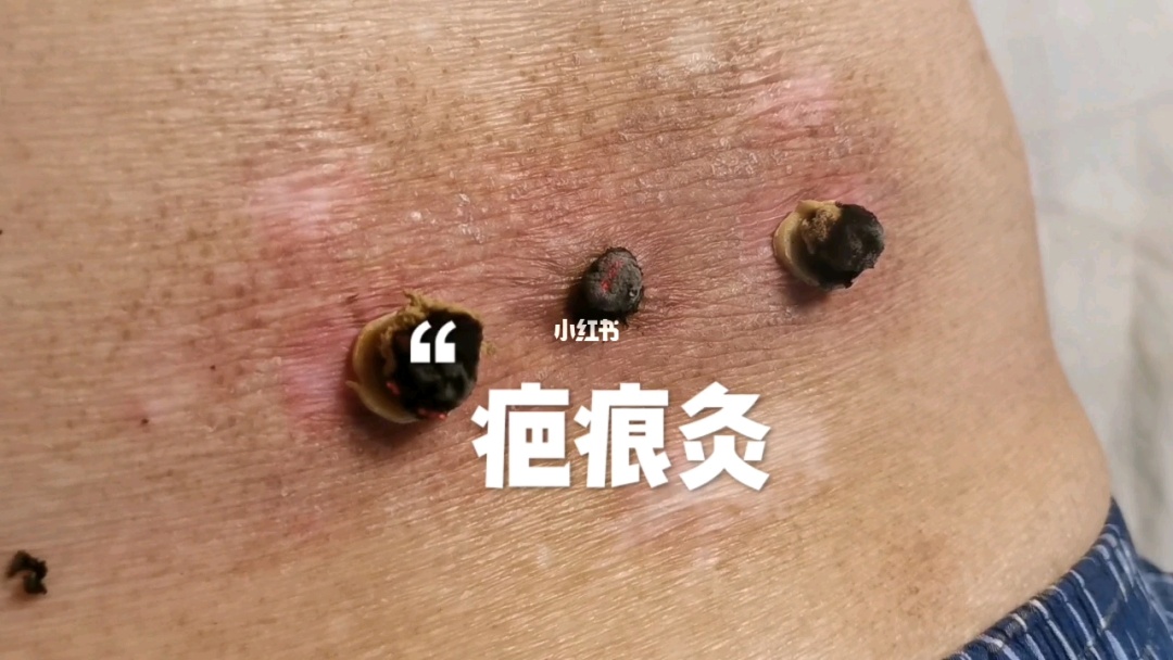 咳嗽的艾灸方法-艾灸治療咳嗽_正確的艾灸方法_艾灸的正確使用順序