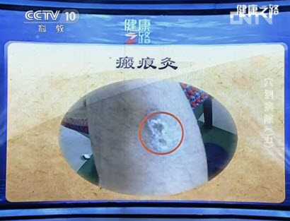 艾灸的正確使用順序_咳嗽的艾灸方法-艾灸治療咳嗽_正確的艾灸方法