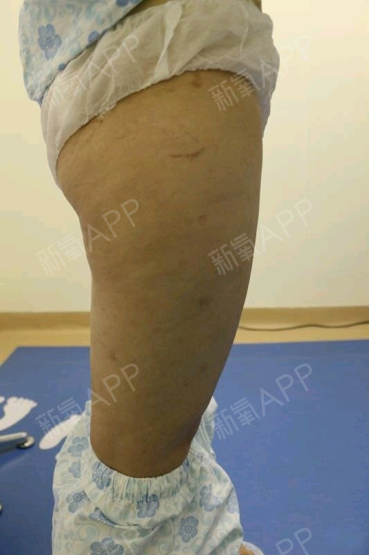 怎樣的運動能快速瘦大象腿_學生怎么快速瘦肌肉腿_不吃藥快速瘦小腿的方法