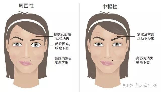 晚期面癱后遺癥_面癱治療土方法_孕晚期面癱的治療方法