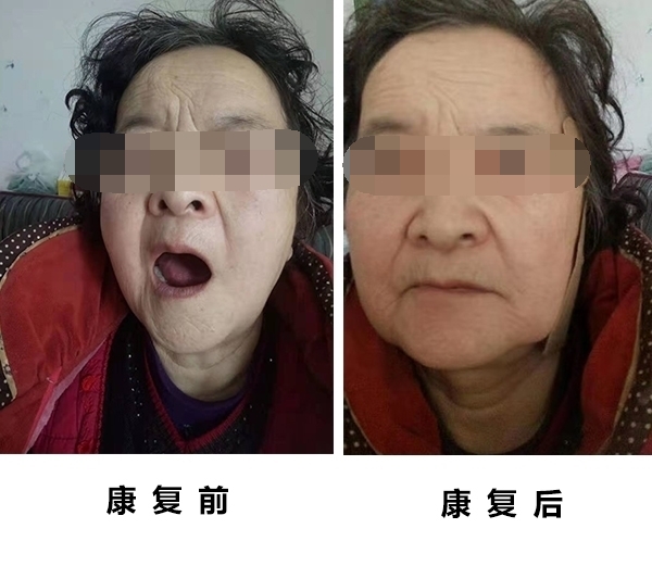 廣州協佳醫院面神經科任飛奔怎么做好預防的發生