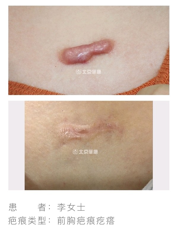 上海治療痤瘡疤痕方法_去疤痕方法_去燙傷疤痕方法