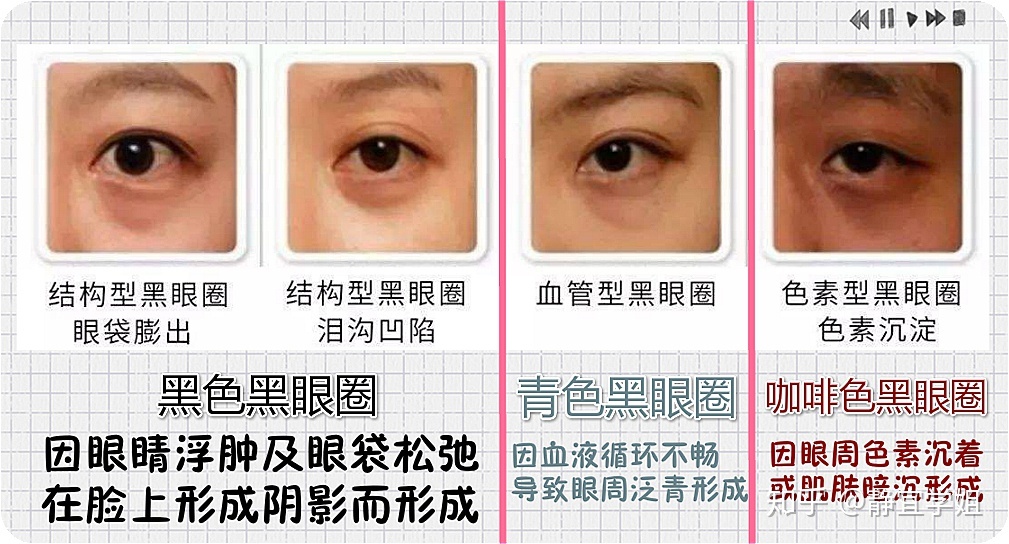 4個導致黑眼圈形成的原因，你中了多少個？