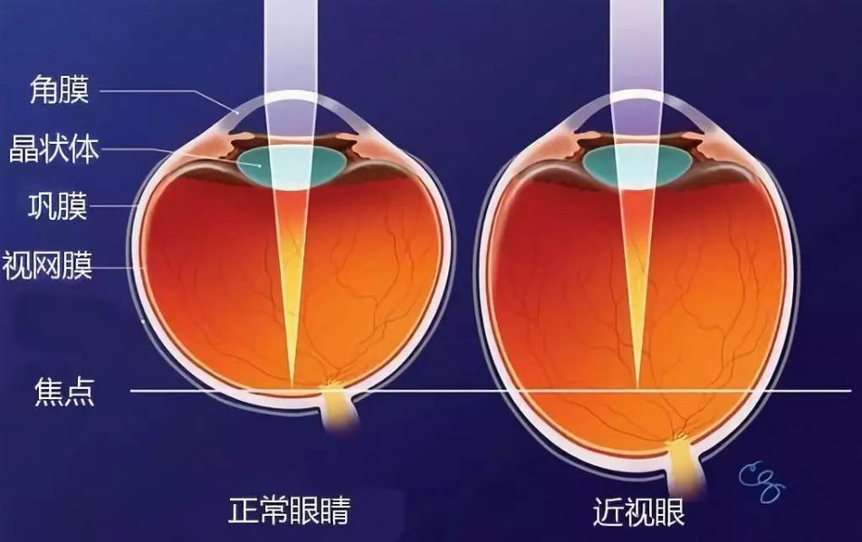 近視眼的治療方法_緩解眼近視最有效的土方法_近視練眼功練好了