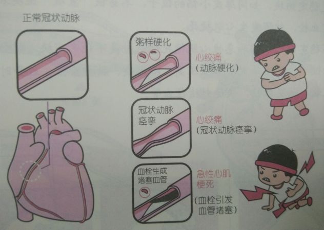 什么是冠心病？該怎么治療？預后如何呢？(圖)