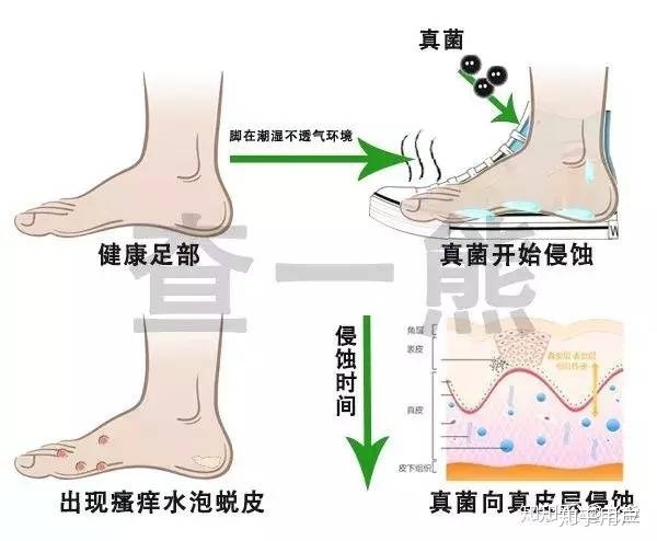 腳氣的治療方法_治療腳氣最快的方法_治療腳氣的最好方法