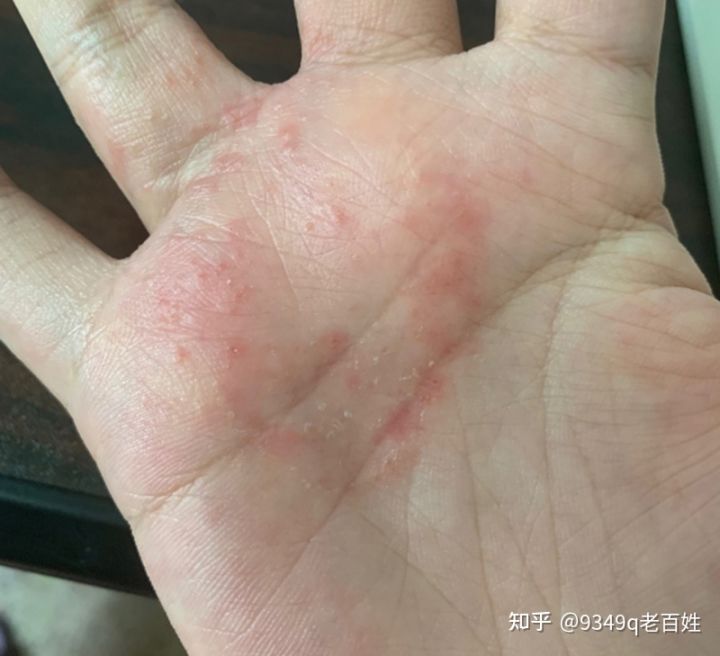 金華治療小孩濕疹土方法_濕疹怎么治療土方法_濕疹怎么治療土方法