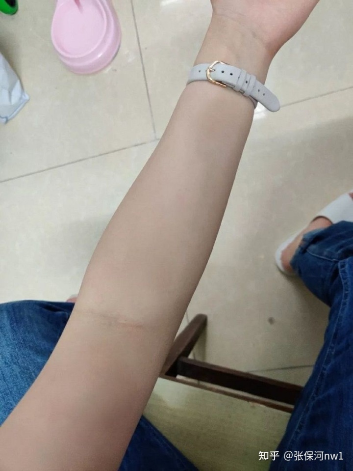 濕疹怎么治療土方法_金華治療小孩濕疹土方法_濕疹怎么治療土方法