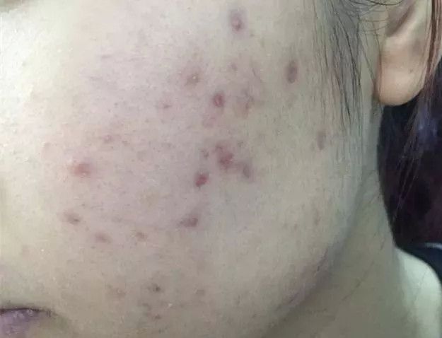 去紅痘印最好的方法_痘印痘坑紅_紅痘印怎么去