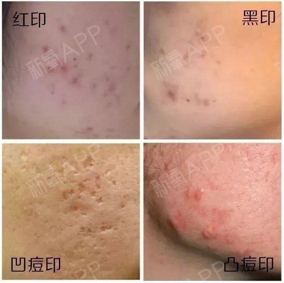 紅痘印怎么去_去紅痘印最好的方法_痘印痘坑紅