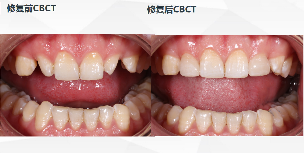 活動義齒修復_義齒修復術/方法_義齒修復后注意