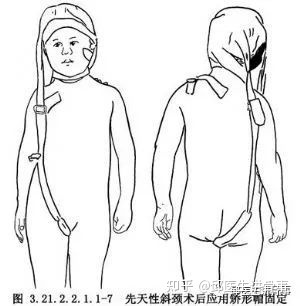 嬰兒斜頸的治療方法_嬰兒斜頸_嬰兒斜頸照片