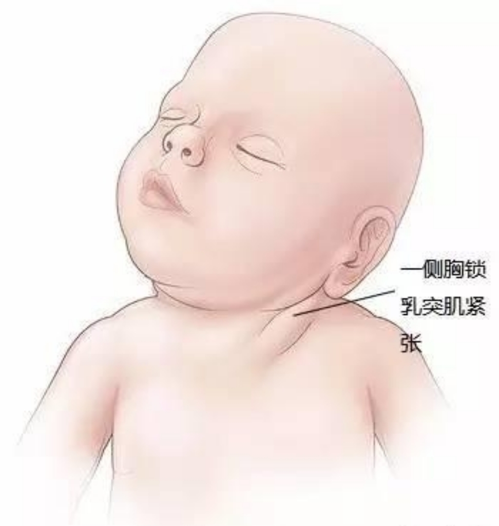 嬰兒斜頸的治療方法_嬰兒斜頸_嬰兒斜頸照片