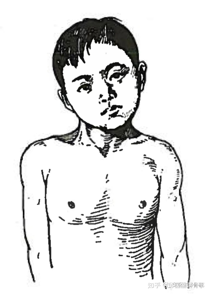 嬰兒斜頸照片_嬰兒斜頸的治療方法_嬰兒斜頸