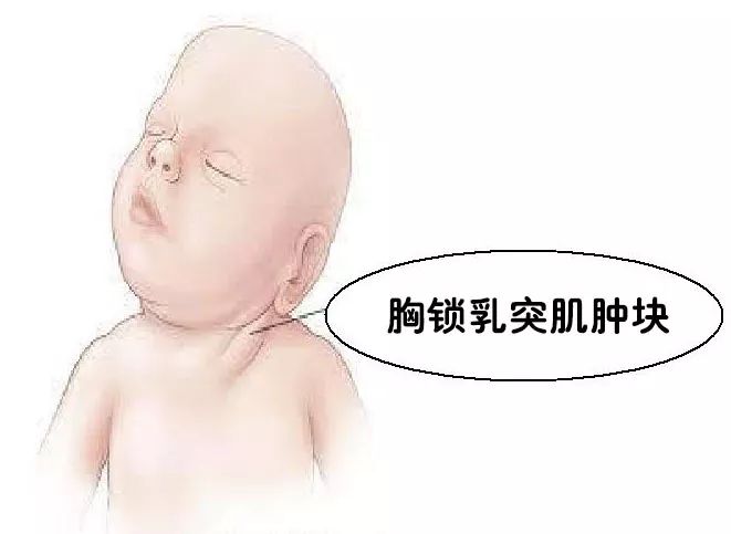 嬰兒斜頸_嬰兒斜頸照片_嬰兒斜頸的治療方法