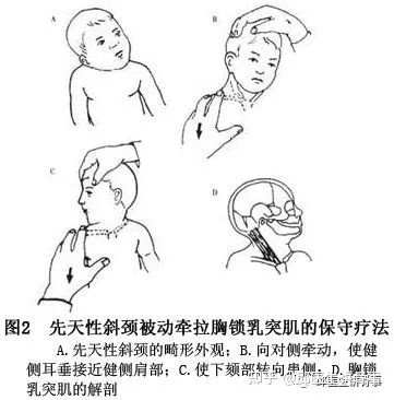 嬰兒斜頸照片_嬰兒斜頸_嬰兒斜頸的治療方法