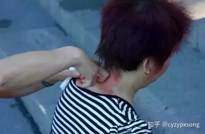 刮痧排毒方法_排毒刮痧對臉有壞處嗎？_美容院刮痧排毒