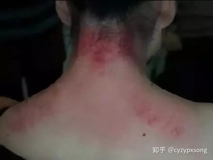 刮痧排毒方法_排毒刮痧對臉有壞處嗎？_美容院刮痧排毒