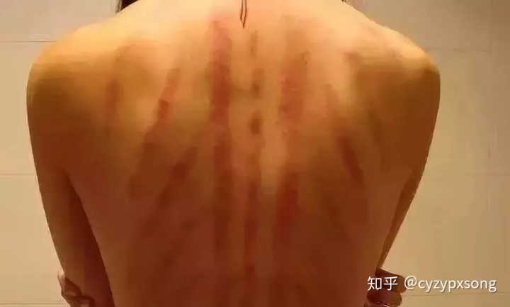 排毒刮痧對臉有壞處嗎？_刮痧排毒方法_美容院刮痧排毒