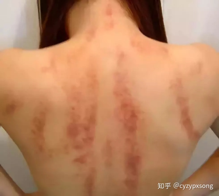 刮痧排毒方法_排毒刮痧對臉有壞處嗎？_美容院刮痧排毒