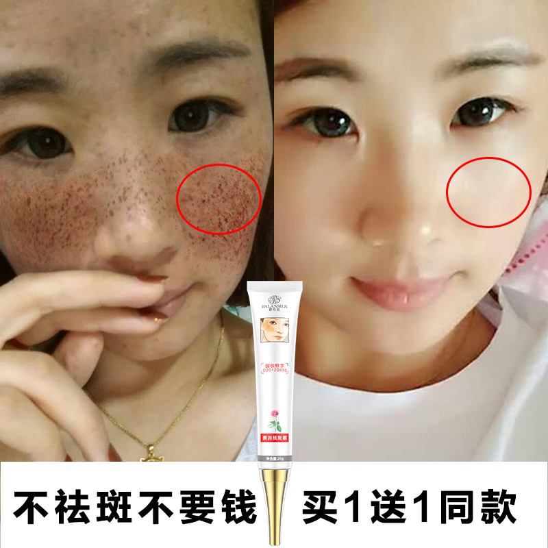 去雀斑最好最快的方法_有效去雀斑民間方法_去雀斑方法