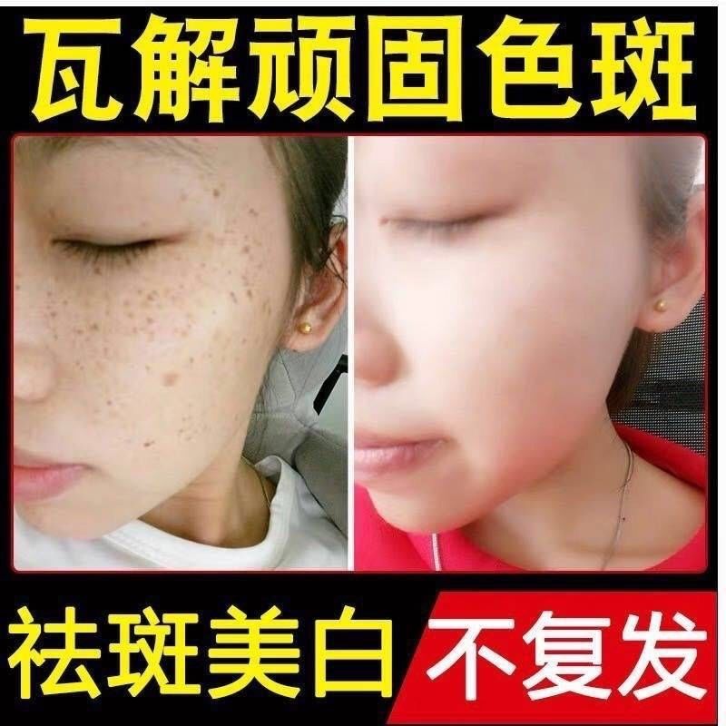 有效去雀斑民間方法_去雀斑方法_去雀斑最好最快的方法