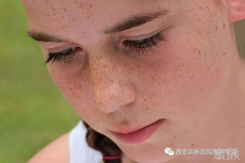 美白去雀斑方法_去雀斑最快的方法_去雀斑方法