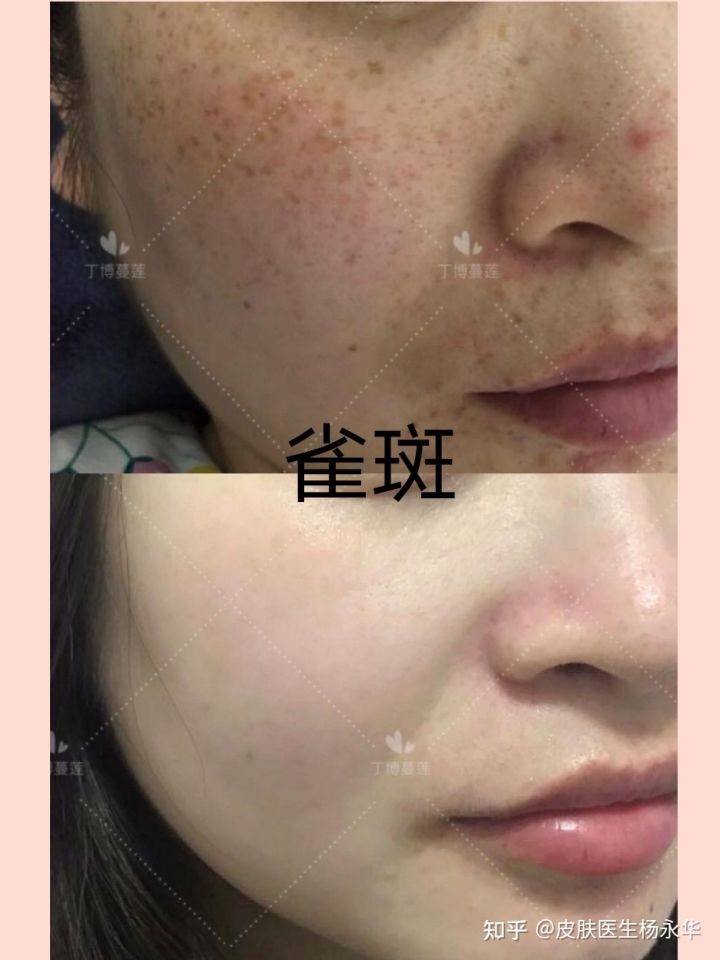 美白去雀斑方法_去雀斑最快的方法_去雀斑方法