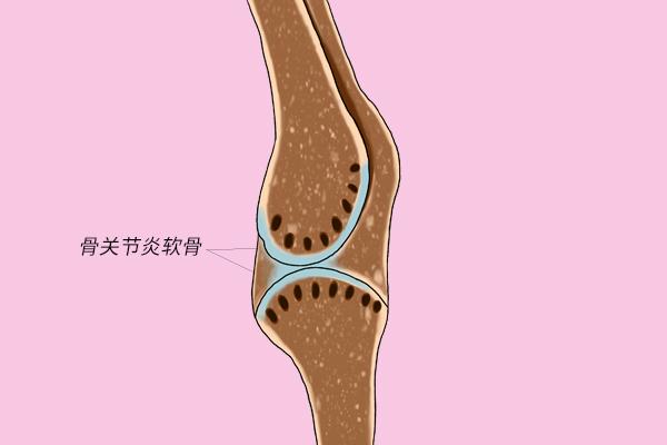 關節炎患者越來越多，究竟是啥原因？(圖)