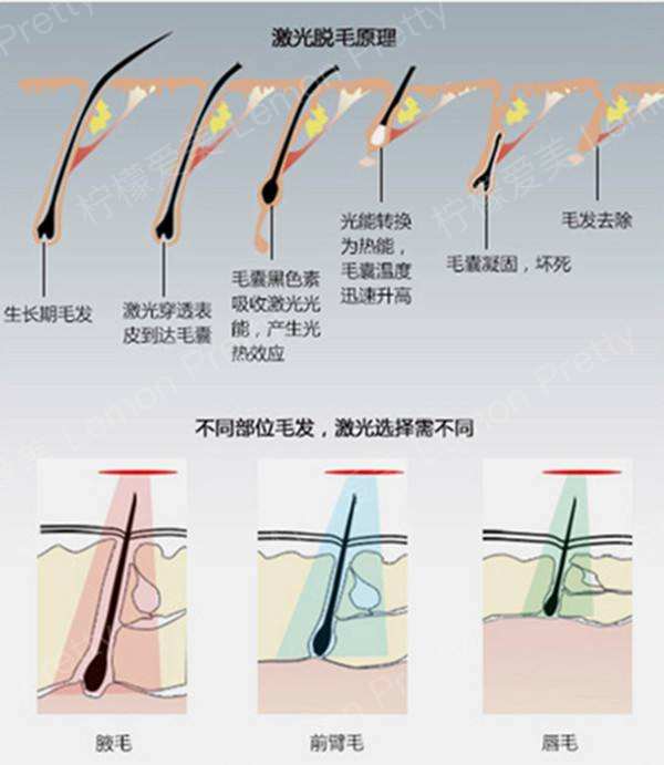激光脫毛法通過產生熱效使毛囊壞死，毛發不再生長
