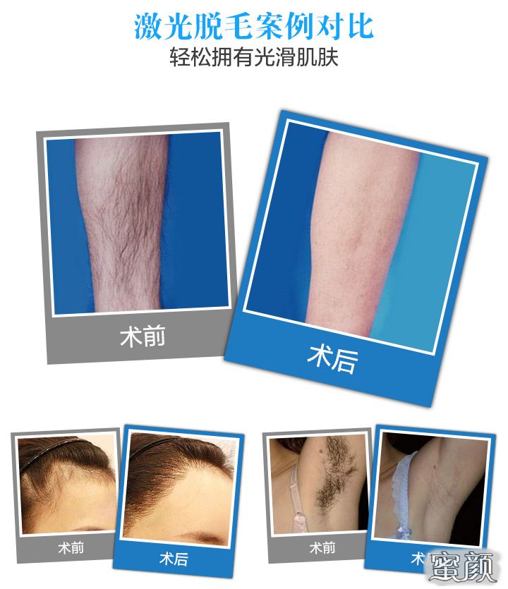 好的脫毛方法好_脫毛方法哪種好_種牙有什么后遺癥種好還是鑲好