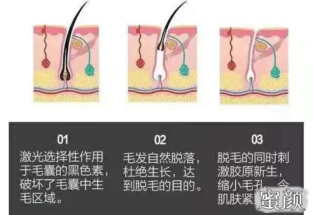 好的脫毛方法好_脫毛方法哪種好_種牙有什么后遺癥種好還是鑲好