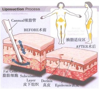 吸脂減肥