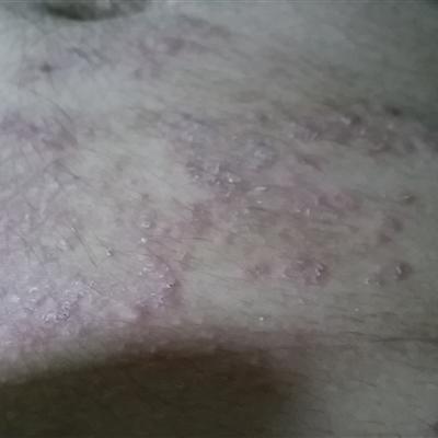 頭皮癬癥狀的治療方法之杭州杭城_治療皮膚癬好的方法_治療銀屑病的方法選杭州杭城