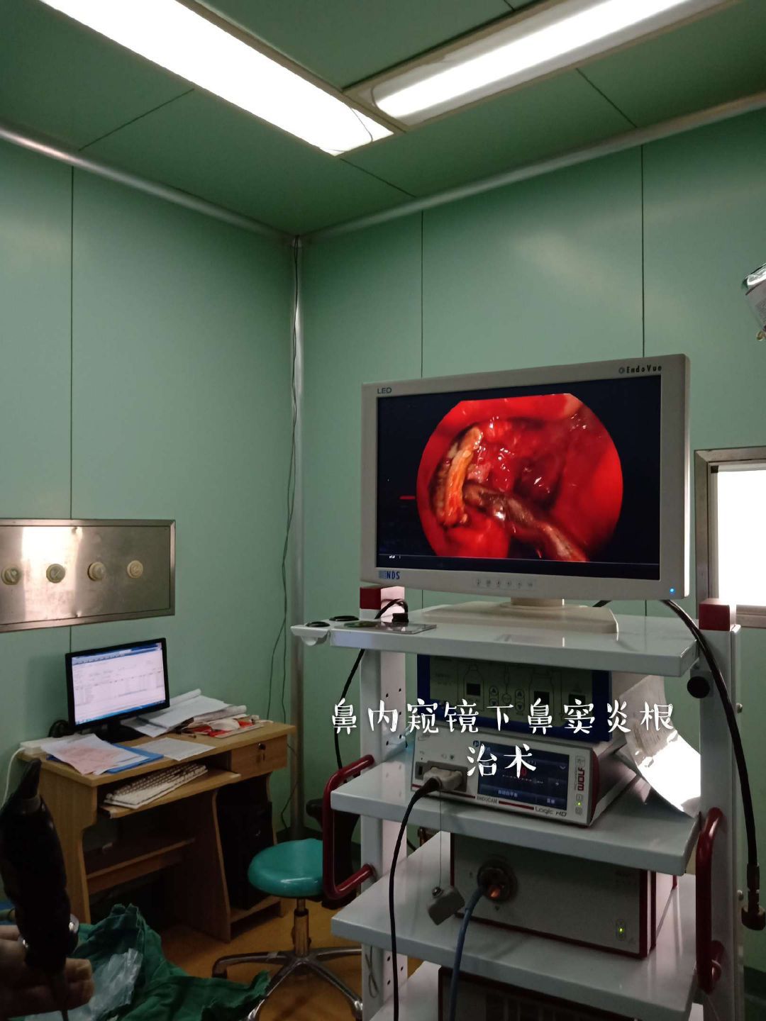 鼻竇疾病的診斷和治療_鼻竇炎的最好治療_鼻竇炎的治療方法,鼻竇炎怎么