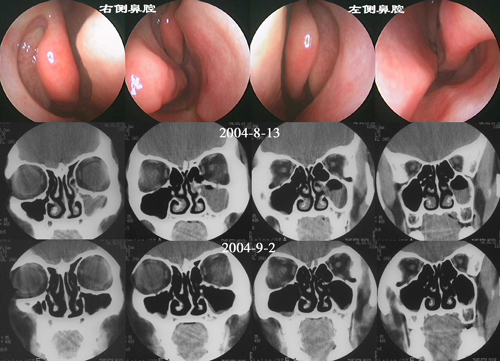 鼻竇疾病的診斷和治療_鼻竇炎的治療方法,鼻竇炎怎么_鼻竇炎的最好治療