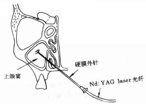 鼻竇炎的治療方法,鼻竇炎怎么_治療強直性脊柱炎方法柱炎_治鼻竇炎的土方法