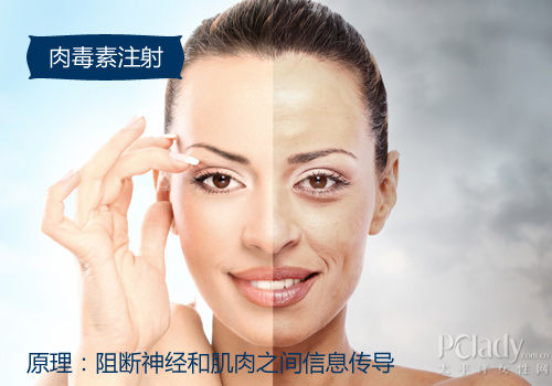 注射肉毒素除皺效果好嗎?新注射尿酸注射除皺方法