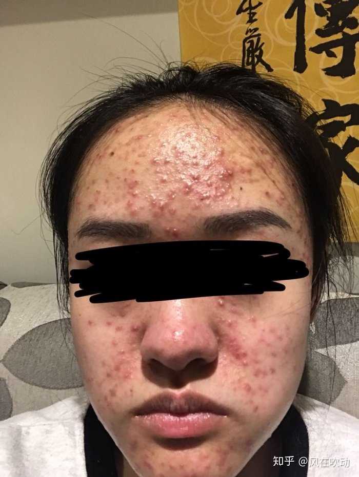 痘痘是什么引起的？鄭州膚康皮膚科醫(yī)生在線介紹