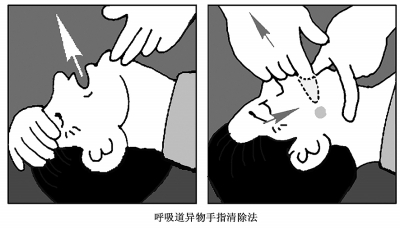 溺水急救先暢通呼吸道，恢復呼吸，再實施心肺復蘇據統計