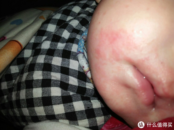 面部慢性濕疹怎么治療_12歲面部濕疹怎么治療_面部濕疹的治療方法