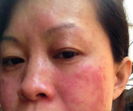 面部輕微濕疹怎么治療_面部濕疹的治療方法_有來醫(yī)生網(wǎng)治療面部濕疹