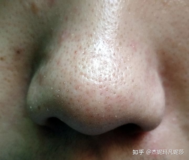 小點就是黑頭的錯誤去黑頭方法介紹及選購方法！