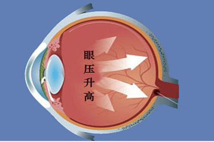 高眼壓癥發展成青光眼的幾率臨床上診斷時必須做眼壓測試