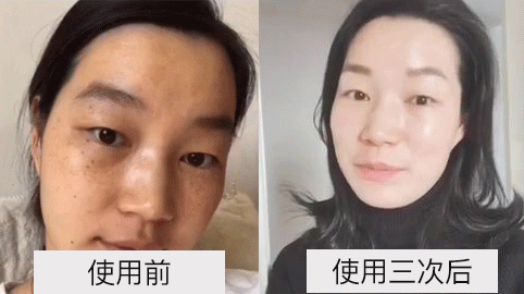 祛雀斑方法就加華美_有效的祛雀斑方法_祛雀斑的最佳方法