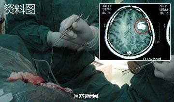女子暴瘦20斤腦內取出27厘米活蟲_寶玉活蟲_睡前一招身高暴長10厘米