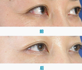 去眼角魚尾紋最好的方法_肉毒 去眼角紋_去眼角紋最好的方法