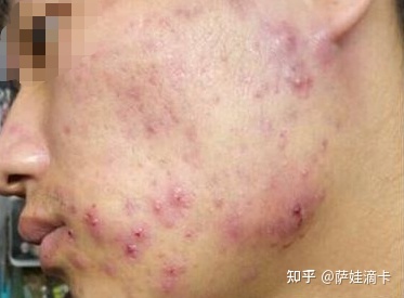 痘印都沒了，實在想不到！測評28天，一一列舉如何快速的淡化痘印！