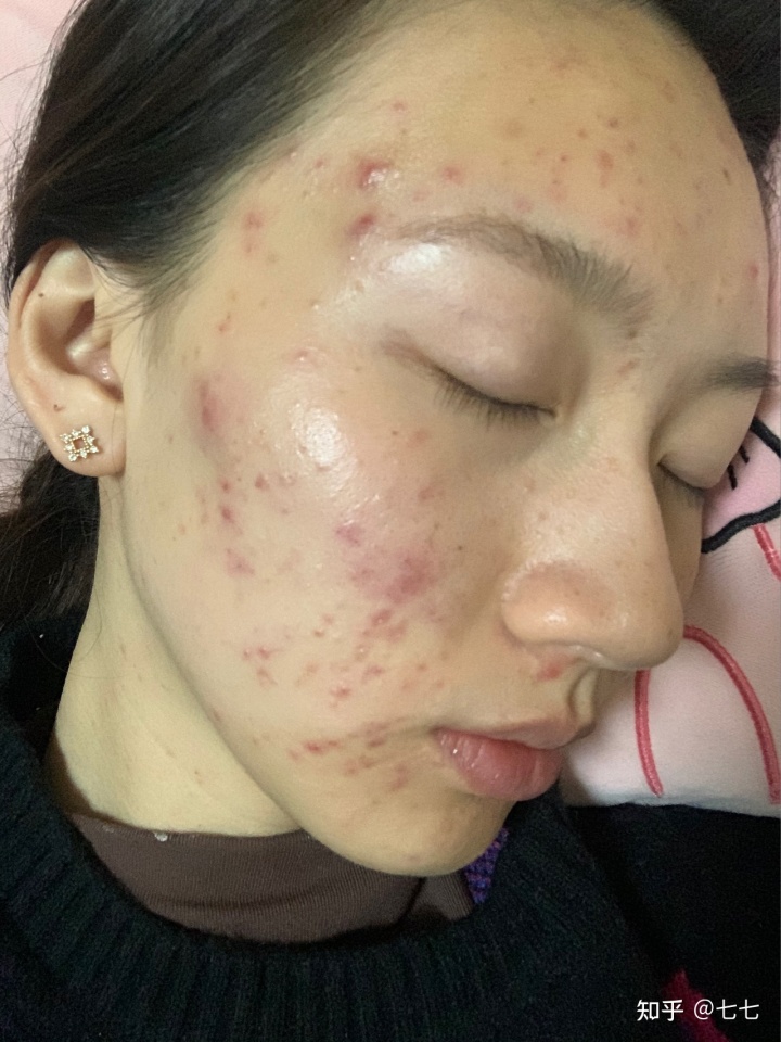 如何讓臉上的痘印消失的話？對(duì)你有所幫助
