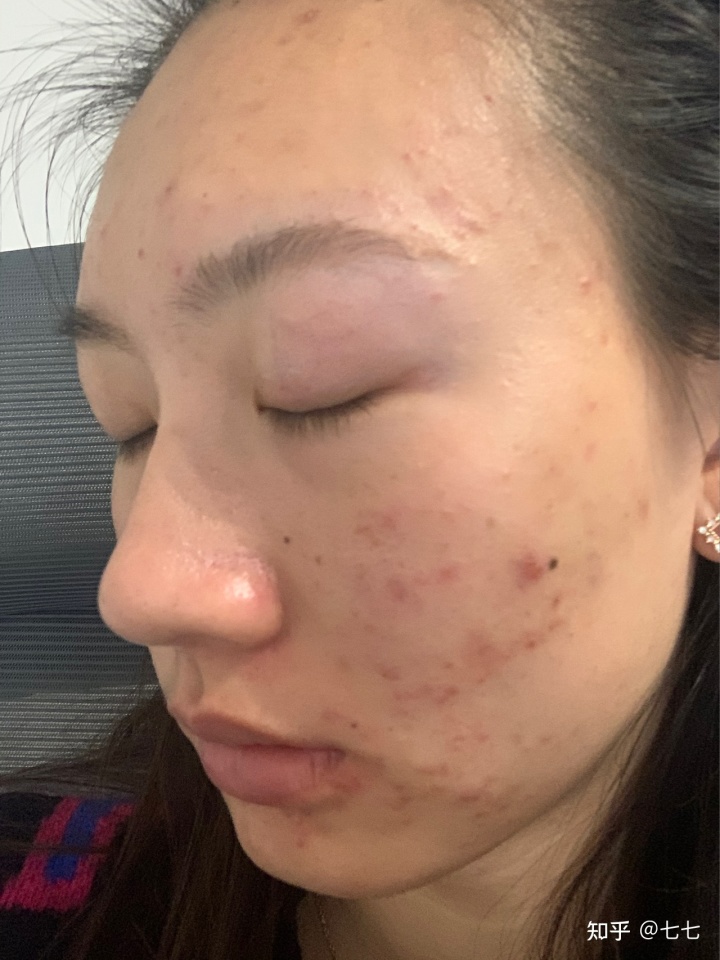 祛痘坑痘印的方法有哪些_痘印祛痘印痘坑_石家莊祛痘坑痘印大約需要多少錢